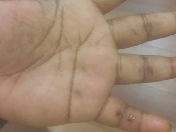 Mão de MC Carol ficou com ferimentos após luta corporal por Reprodução/Facebook