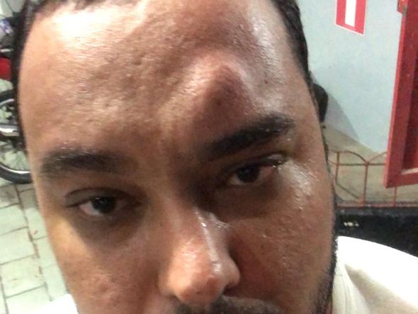 Rodrigo Matos levou uma garrafada na testa durante evento político nem Ribeira do Pombal por Acervo pessoal