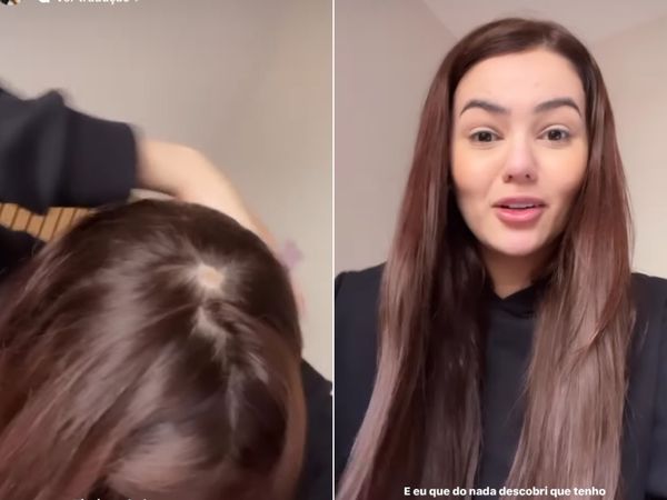 Eslovênia Marques revela ter alopecia