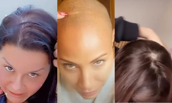 Famosas relatam alopecia
