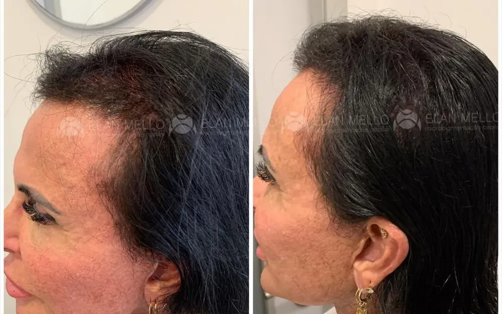 Gretchen revela alopecia por Redes sociais