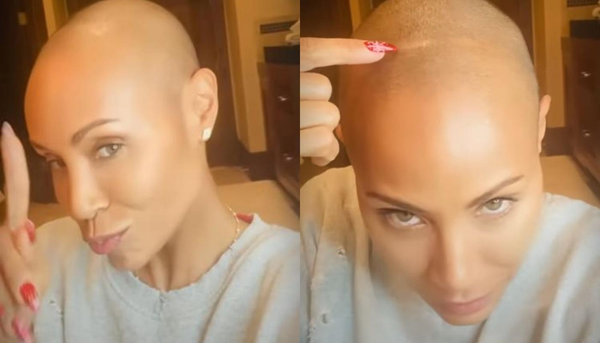 Jade Smith com alopecia
