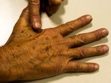 Imagem - Mutirão gratuito de prevenção ao câncer de pele acontece sábado (13) em sete municípios da Bahia