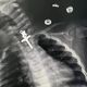 Imagem - Exame de raio-x revela crucifixo preso em garganta de bebê de 10 meses no Peru