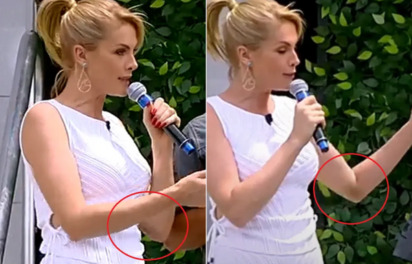 Ana Hickmann aparece com hematomas