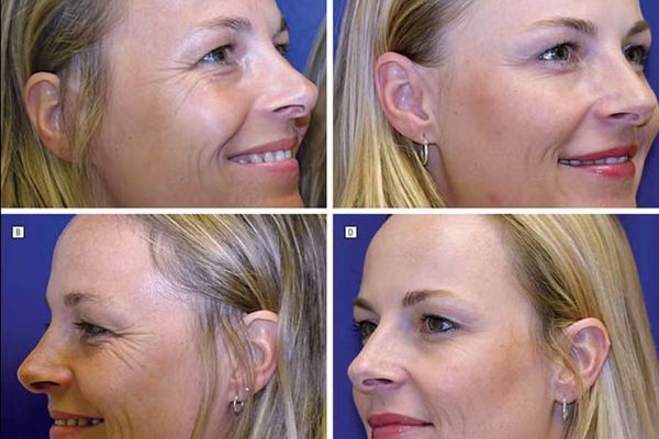 À esquerda, gêmea que não faz tratamento regular com botox; à direita, gêmea que faz tratamento de duas a três vezes por ano