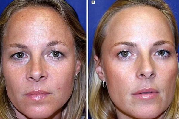 À esquerda, gêmea que não faz tratamento regular com botox; à direita, gêmea que faz tratamento de duas a três vezes por ano