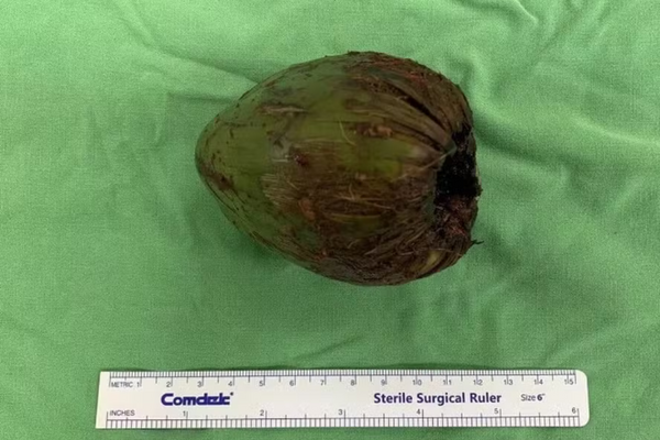 Homem é operado de emergência em Taiwan após inserir coco no corpo para estimulação sexual