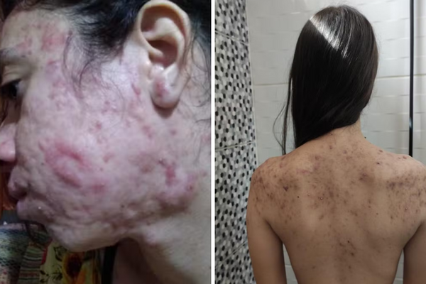 Eduarda Lemes, de 23 anos, começou a ter acne com 9