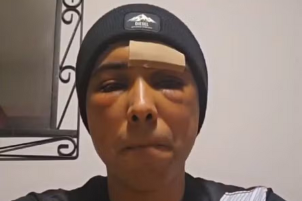 Brasileiro foi atacado no rosto com taco em rua na Irlanda