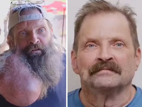 Imagem - Americano tem tumor removido do rosto e do pescoço após 16 anos