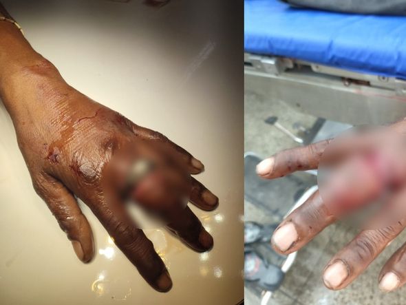 Imagem - Com anel preso no dedo há um mês, homem é anestesiado para retirada do acessório