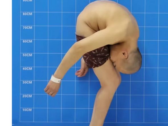 Imagem - Após 28 anos andando 'dobrado', homem faz cirurgia e consegue andar ereto pela primeira vez