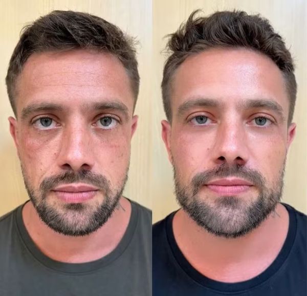 Rafael Cardoso mostra o antes e o depois após harmonização facial