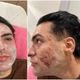 Imagem - Paciente que morreu após procedimento de peeling teve edema pulmonar por inalar fenol