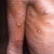 Imagem - Mpox: conheça sintomas e tire principais dúvidas sobre a doença