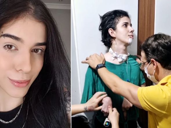 Imagem - Jovem que teve grave reação alérgica após inalar pimenta aparece de pé durante fisioterapia; veja vídeo