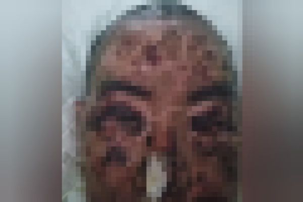 Modelo desfigurada após antibiótico
