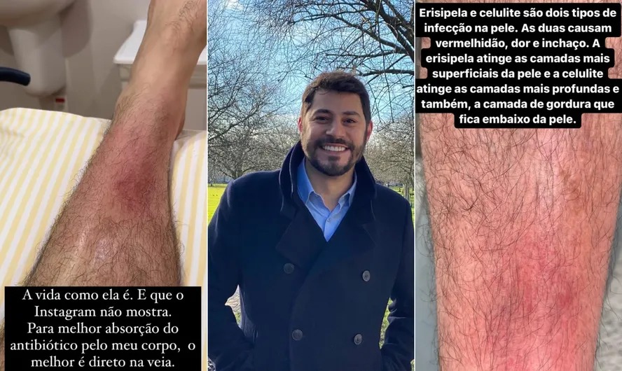 Evaristo Costa explica sobre doença de pele por Redes sociais