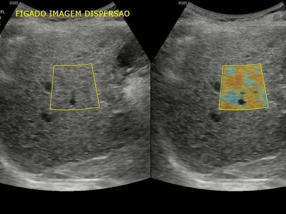 Imagem - Clínica oferece exames gratuitos para pessoas com gordura no fígado