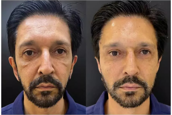 Antes e depois de Ricardo Nunes