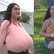 Imagem - 10 quilos de seios: entenda o que é gigantomastia, doença que afeta jovem no Paraná