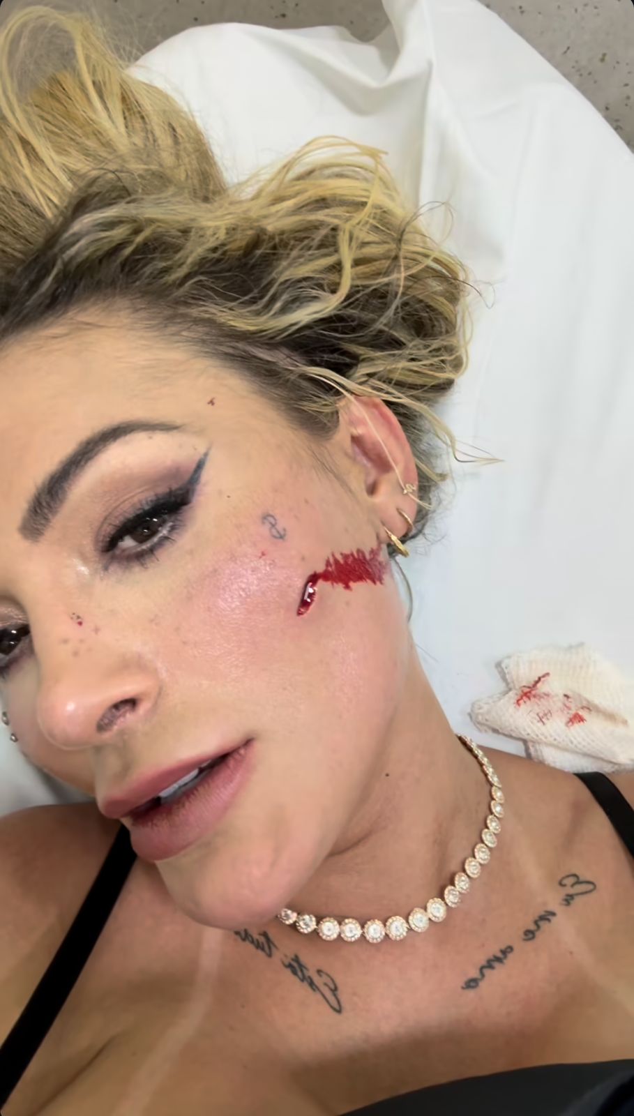 Andressa Urach com corte no rosto por Reprodução / Redes Sociais