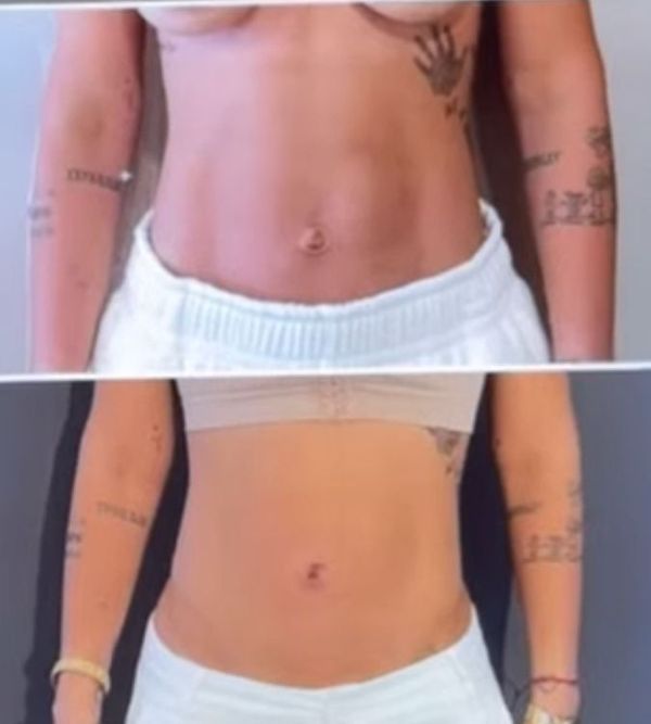 Antes e depois da retirada de hérnia umbilical