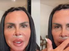 Imagem - Gretchen remove preenchimento labial com substância de risco