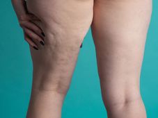 Imagem - Lipedema X Celulite: como saber diferenciar e quando procurar um médico