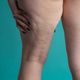 Imagem - Lipedema ou Celulite? Saiba como diferenciar e quando procurar um médico