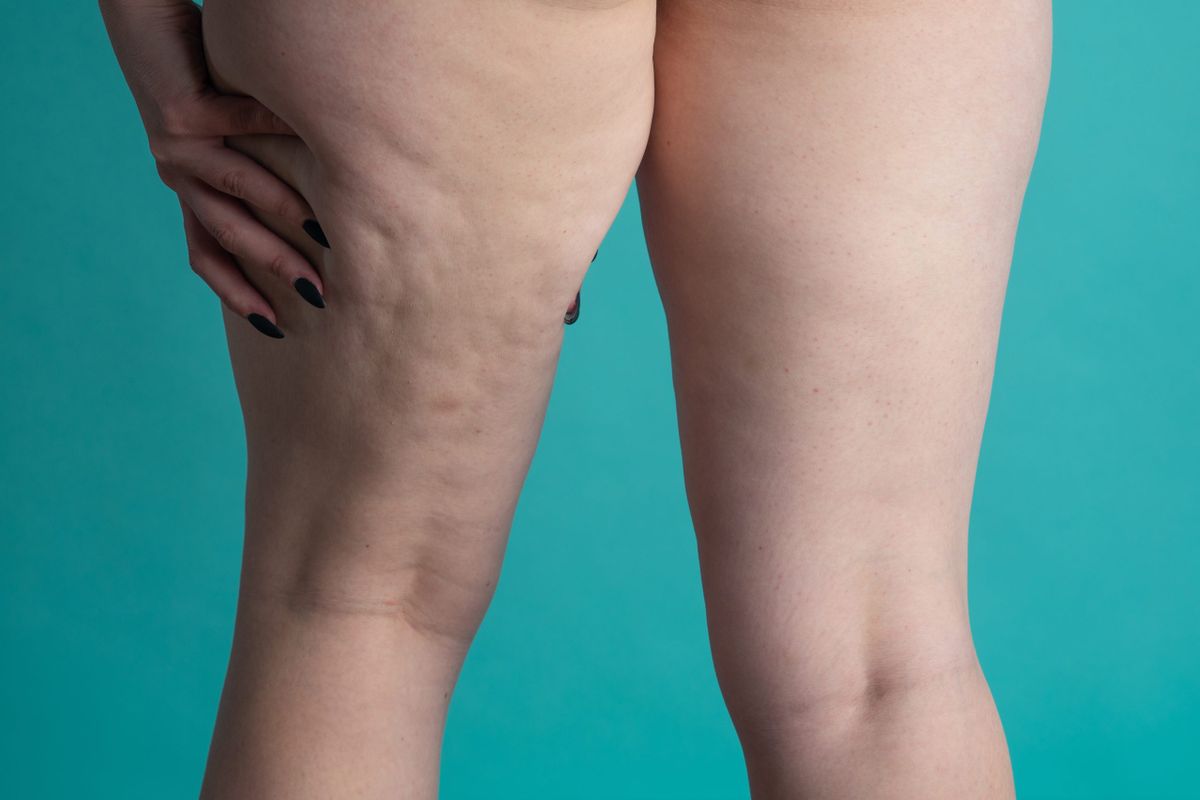 Lipedema