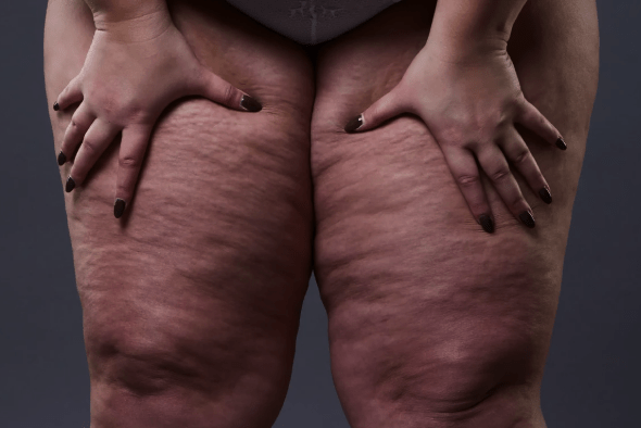 Lipedema