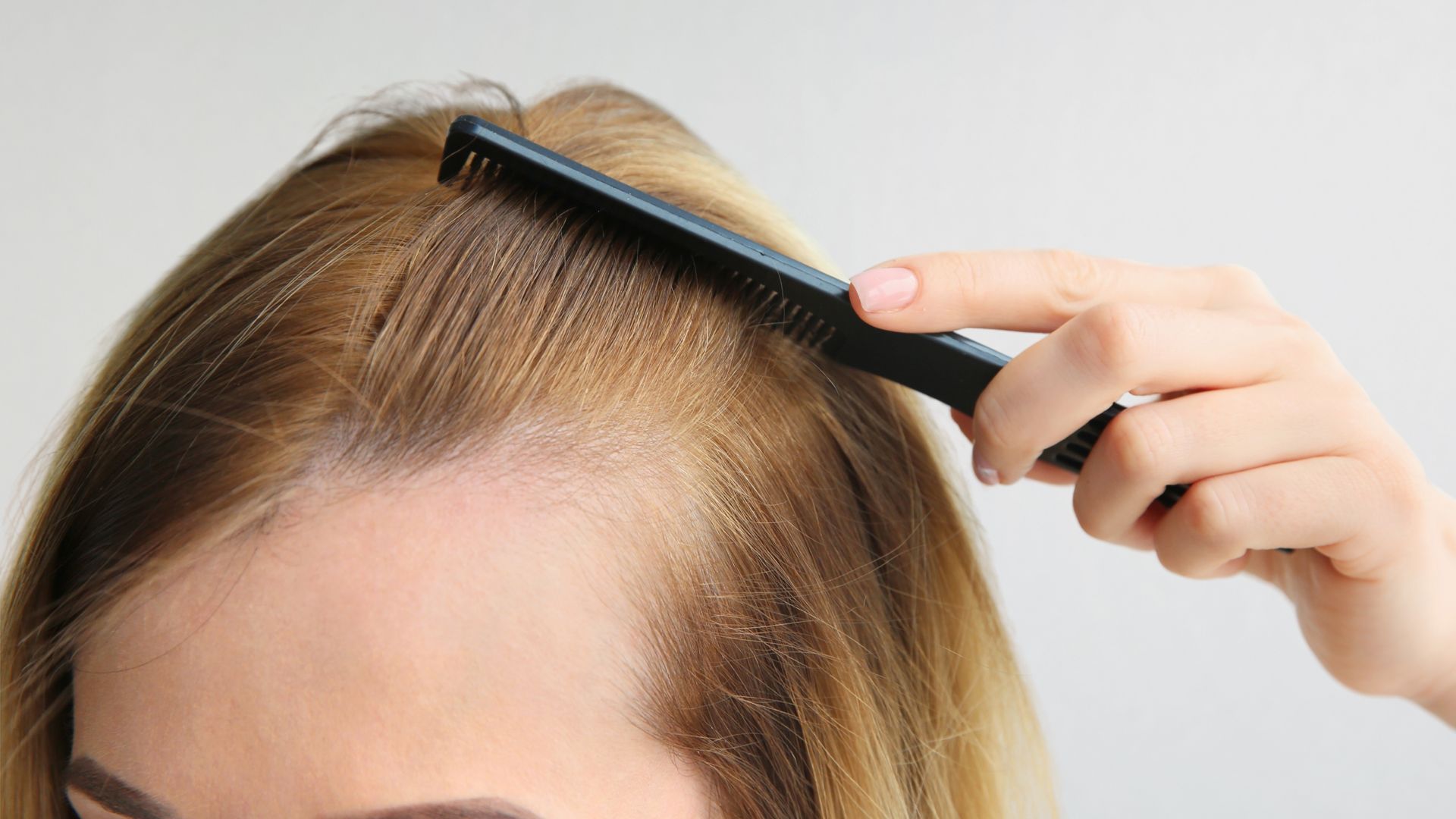 Imagem - Alopecia feminina: causas, diagnóstico e os tratamentos mais eficazes