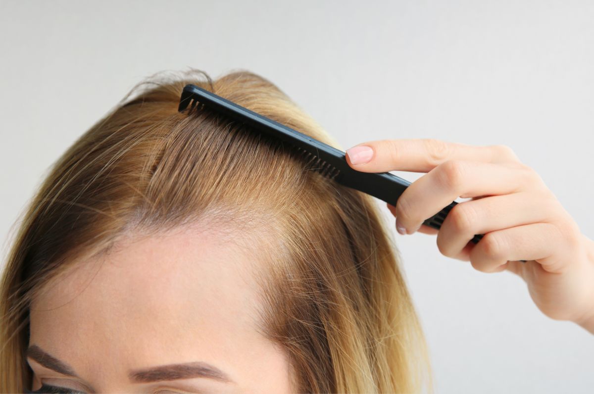 Há novos estudos sobre alopecia