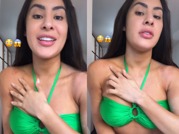 Isabelle Nogueira mostra marcas no corpo nos stories