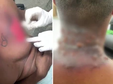Imagem - Ouça relato do soldado que teve queimaduras graves em treinamento da PM: 'Pó de granada'