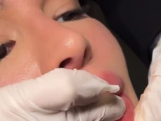 Imagem - ANTES x DEPOIS: ex-BBB remove preenchimento labial: 'Agora vejo até mais meus dentes'
