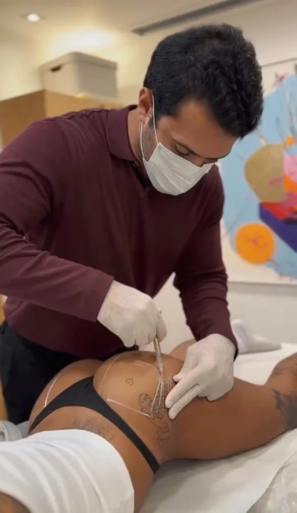 Dhiô Barbosa mostrou bumbum após procedimento estético