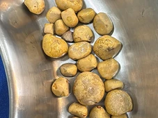 Imagem - Médico retira 35 pedras da bexiga de homem que bebia coca-cola todos os dias