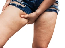 Imagem - Celulite 'teen': especialistas explicam por que os 'furinhos' surgem na adolescência e o que fazer