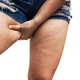 Imagem - Celulite 'teen': especialistas explicam por que os 'furinhos' surgem na adolescência e o que fazer