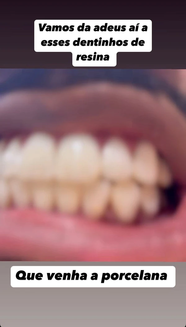 Anúncio dos novos dentes de porcelana por Reprodução
