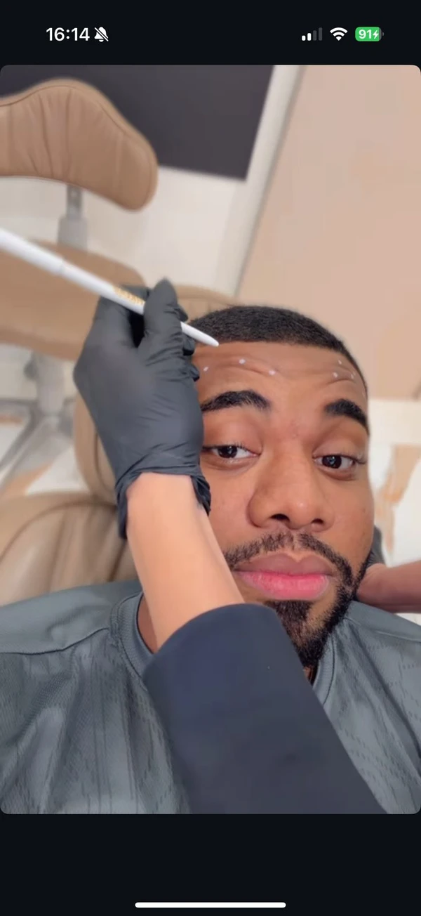 Aplicação de botox por Reprodução