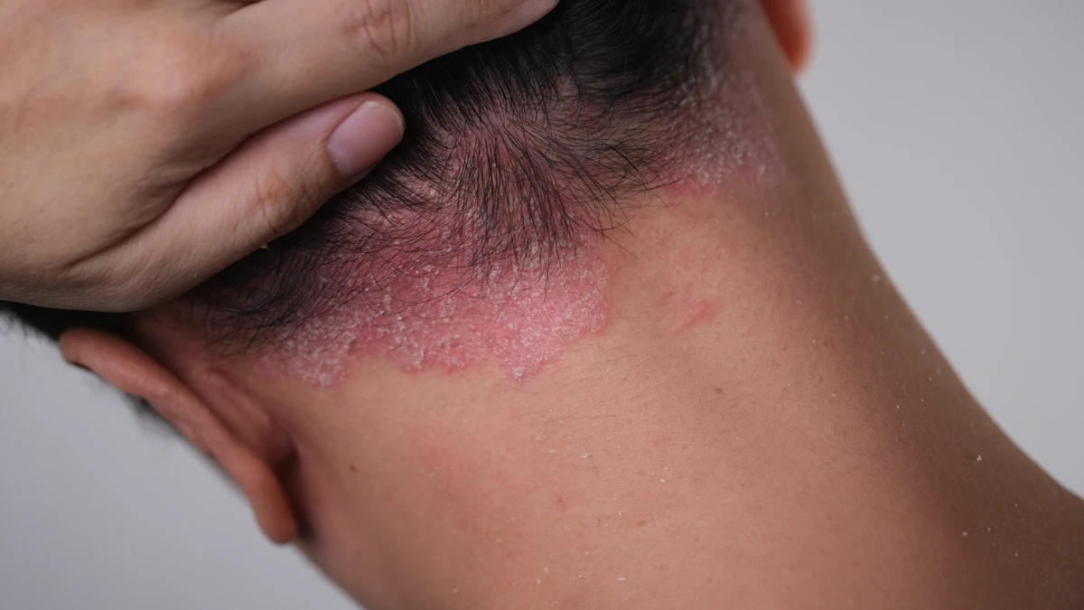 Uma das doenças listadas é a dermatite seborreica 