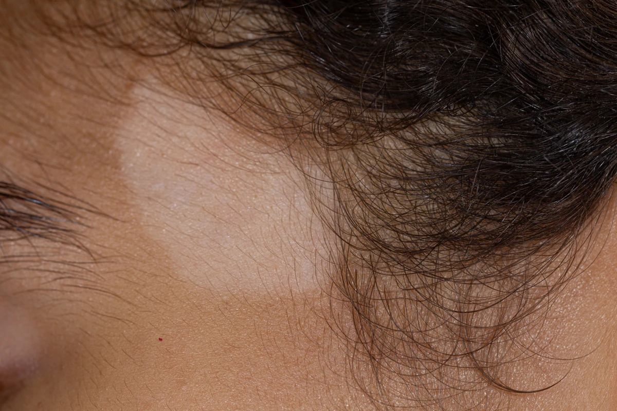 Vitiligo
