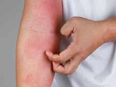 Imagem - Tratamento para dermatite atópica passa a ser oferecido pelo SUS; saiba como