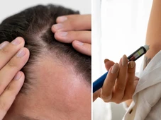 Imagem - Magro e... calvo: entenda por que canetas emagrecedoras podem causar queda de cabelo