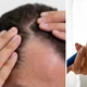 Imagem - Magro e... calvo: entenda por que canetas emagrecedoras podem causar queda de cabelo