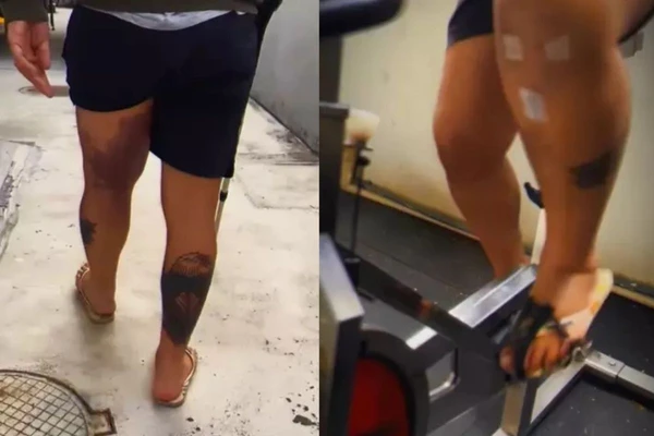 Juliana Cazarré exibe hematomas na perna por Reprodução